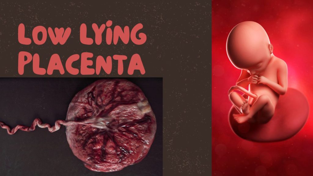 low lying placenta