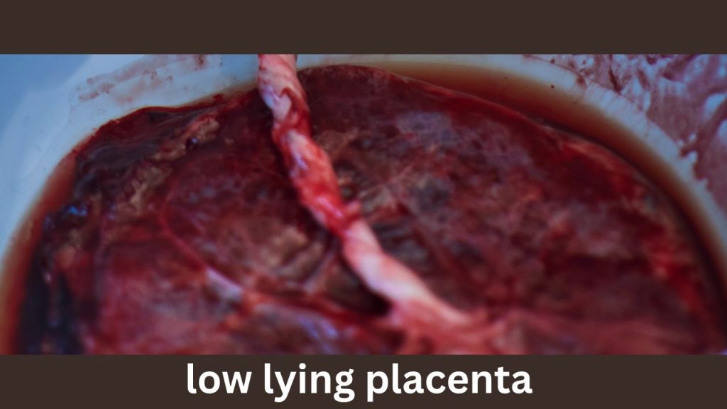 low lying placenta 