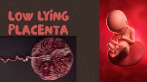 low lying placenta
